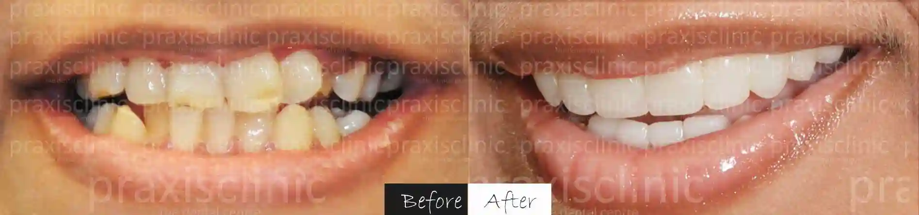 Before and After results of Smile Makeover at Praxis Dental best cosmetic dentistry clinic in Mumbai